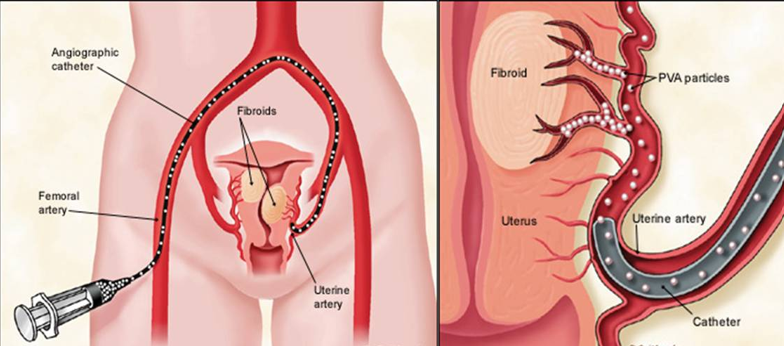 Pelvic Congestion Syndrome - Ovarian Vein Embolization